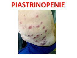 Francesco rodeghiero, fondazione progetto ematologia vicenza, dipartimento di ematologia, ospedale s. Piastrinopenia