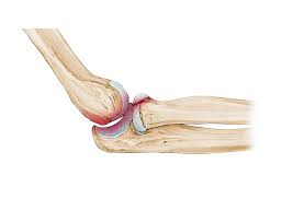 Radial Head Fracture