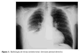 Check spelling or type a new query. Mesotelioma Pleural Maligno
