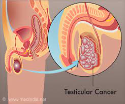 A seminoma is a malignant tumour (cancer) of the testis (testicle). Why Is Chemotherapy So Effective In Testicular Cancer Treatment