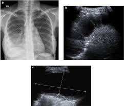 Learn about pleural effusion (fluid in the lung) symptoms like shortness of breath and chest pain. A Chest Radiograph Shows A Right Loculated Pleural Effusion B C Download Scientific Diagram