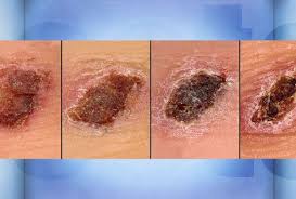Crostres Evolucio Scab Healing Heal Scabs Faster Skin Healing