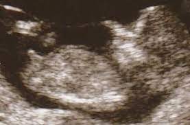 Wann kann man per Ultraschall das Geschlecht erkennen? - BabyCenter