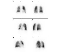 Image result for Ventilation Perfusion Scan