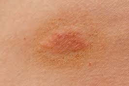 Coming up, we're going to show you cleaners that kill these 3 ringworm causing skin plants once and for all on hard surfaces. Ringworm Articles Dis Chem