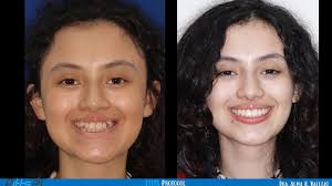 Dra. Alma Vallejo SMILEHAUS Ortodoncia (@dra.almakvallejo) · Instagram 照片和视频