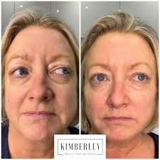 Subtle volume replacement 💉 Dermal filler treatment for the rejuvenation  of the mid-face. Dermal fillers seem to be getting a real bashing in the  media recently. And with some of the images