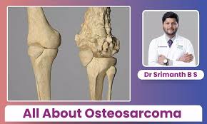 Image result for Osteosarcoma