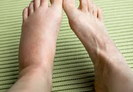A person can lose weight in their feet due to loss of muscle mass as well as fluid retention. What You Should Know About Swelling In Your Legs Health Essentials From Cleveland Clinic