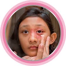 Image result for ekzema face