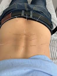 Acupuncture Chronic Low Back Pain Acupuncture Zen Delray Beach