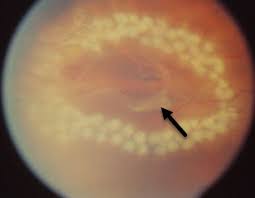 Simulate your vision for family, friends, and eye doctors. Retina Louisville Retinal Detachment Louisville Bennett Bloom