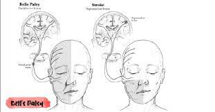 Check spelling or type a new query. Dr Iskandarmirza On Twitter Stroke Vs Bell S Palsy Continue When Cortex Is Injured There S Weakness In The Contralateral Lower Face Only Stroke When The Facial Nerve Is Injured There S Weakness In The Ipsilateral