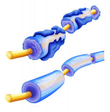 Check spelling or type a new query. Scleroza Multipla Scleroza In Placi