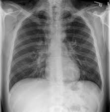 Pneumothorax occurs when air enters the space around your lungs (the pleural space). Cough Induced Bilateral Spontaneous Pneumothorax The Annals Of Thoracic Surgery
