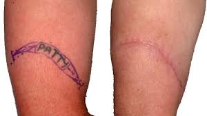 Here, i explain my experiences with both laser removal and excision surgery for anyone who is interested. Tattoo Removal Surgery In Bangalore Dr Shettys Cosmetic Clinic