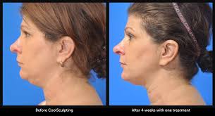 Coolsculpting body contouring treatments use cryolipolysis, or fat freezing, to target stubborn areas of fat without surgery. Coolsculpting Before And After Photo Gallery Dr Kane