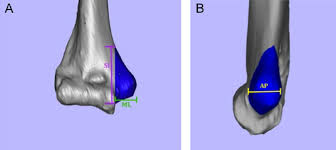 A straightforward prominence on the bone the place it varieties a joint with one different bone that is situated on the lower side. Linear Measurements Of The Medial Epicondyle The Medial Epicondyle Download Scientific Diagram