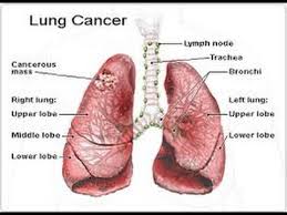 Get the facts on lung cancer types, symptoms, causes, treatment, and stages. Signs Of Lung Cancer Youtube