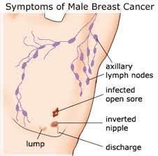 Cancer symptoms vary depending on many factors, such as the cancer type, stage, size and location. Chisipite Medical And Dental Centre Symptoms Of Breast Cancer In Men Symptoms Of Breast Cancer In Men Are Similar To Those In Women Most Male Breast Cancers Are Diagnosed When A