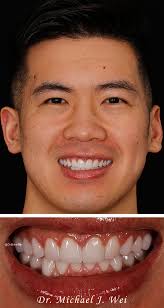 Daniel's Life-Altering Smile Makeover of Veneers and Crowns