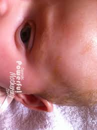 Be sure the shampoo doesn't get in your baby's eyes, as it may cause irritation. How To Treat And Get Rid Of Cradle Cap For Good With Simple Herbs