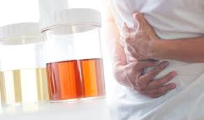 In the first, water is injected into the prostate using a probe passed up the urethra. Prostate Cancer Symptoms Having This Colour Urine Could Be Warning Sign Of The Disease Newsgroove Uk