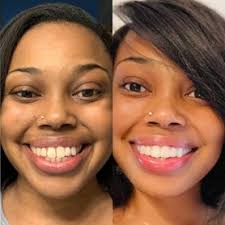 Transform Your Smile with CandidPro Clear Aligners at Vitality Dental