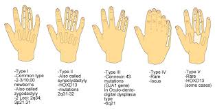 Image result for Syndactyly