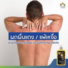 Rash Redness Itching Sweat Allergies Don T Worry Just Take A Shower With Shower Cream Naga In 2020 Prevention Itch Sweat