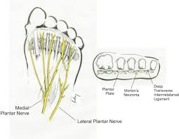 Check out their videos, sign up to chat, and join their community. Diagnosis And Treatment Of Forefoot Disorders Section 3 Morton S Intermetatarsal Neuroma The Journal Of Foot And Ankle Surgery