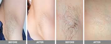 George hopper rd., suite 101, burlington, wa 98233 | ph: Laser Hair Removal Kucumber