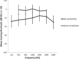 Prevalence And Nature Of Hearing Loss In 22q11 2 Deletion Syndrome Journal Of Speech Language And Hearing Research