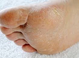 La partie du corps de l ' homme qui est à l ' extrémité de la jambe et qui lui sert à se soutenir et à marcher. Mieux Comprendre Le Pied Du Diabetique Pour Mieux Vivre Avec