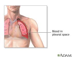 Image result for Chest Tube