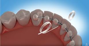 Order a sporting smiles impression kit and receive a custom essix retainer in as little as two weeks. How To Floss With A Permanent Retainer Premier Orthodontics