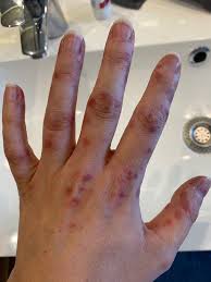 Hand Mund Fuss Bei Erwachsenen Ansteckend Und Schmerzhaft Hand Mund Fuss Mund Hautausschlag