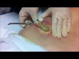 Pin On Pimple Popping