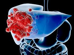 However, as with other types of cancer,. Liver Cancer Poland Pdf Ppt Case Reports Symptoms Treatment
