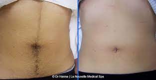 Call today to schedule your complimentary laser hair removal consultation to decide if laser is right for you. Laser Hair Removal Before And After Photos Oxnard Ventura