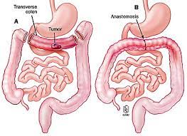 What do you prefer to learn with? ç›´è‚›å¤–ç§' Colorectal Resections ç™½è¢ææ‡¼ç—‡ ç—žå®¢é‚¦