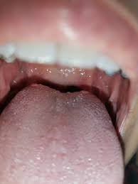 Image result for papillomavirus tongue)
