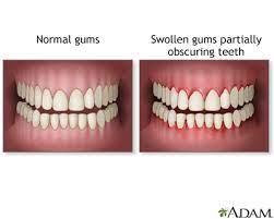 Practicing good oral hygiene can help a person keep their gums healthy and reduce the risk of gum disease. Gums Swollen Information Mount Sinai New York