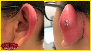 We Have Never Seen A Piercing This Swollen Youtube