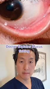 What does she pull out of her eye? 👁️ #mucusfishing #mucusfishingsyndrome  #doctorreacts