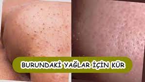Burundaki Siyah Noktalar Icin Kur Tarifi Bursa Tarifler Saglik