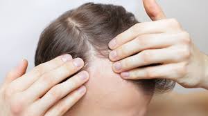 Best salon for mens haircut hyderabad the best model. Hairstylist Explains Hair Loss Thesalonguy Youtube