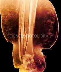 Elephantiasis Mri Scan Showing A Section Through The Lower Leg Of A Patient With Elephantiasis A Condition Where The Lymph Vessels Become Parasite Mri Human