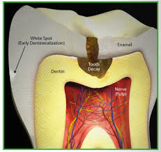 Dental caries not to be. Tooth Decay Cavities City Dentists Wellington