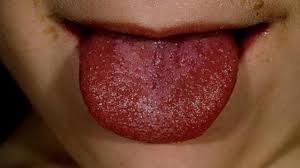 Penyebab Lidah Terasa Pahit Saat Demam Dan Cara Mengatasinya Hot Liputan6 Com